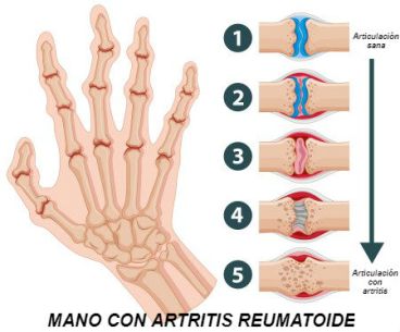 artitris reumatoide global fios artitris reumatoide global fios