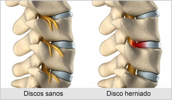 hernia discal diagrama hernia discal diagrama